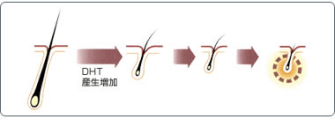 DHT産生増加によるヘアサイクルの変化