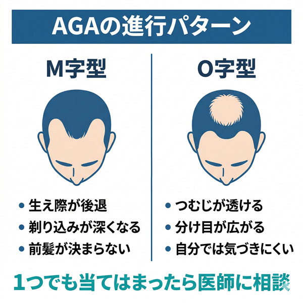 AGAの進行パターン。M字型は生え際の後退・剃り込みの深化、O字型はつむじ透け・分け目の広がりが特徴