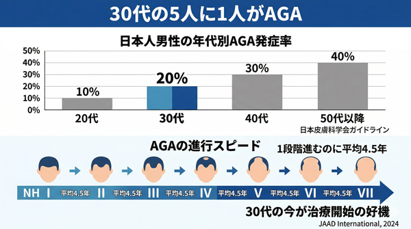 日本人男性の年代別AGA発症率（20代10%・30代20%・40代30%・50代以降40%）とAGAの進行スピード（1段階に平均4.5年）